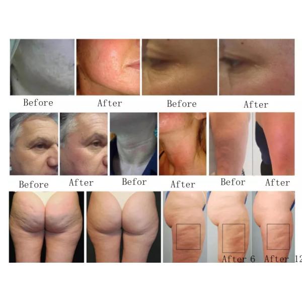 Внутренний целлюлит ролика шарика уменьшает для вакуума /body стороны уменьшая машину красоты