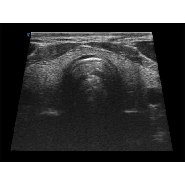 15.6 Inch LED SonoScape Portable Color Doppler Ultrasound Machine BW Ultrasound