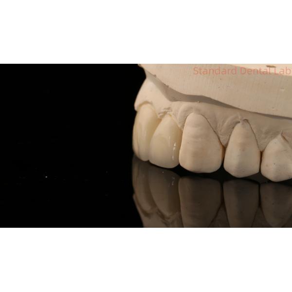 Strong Layered Zirconia Crown And Bridge In Good Esthetics Zirconia Layered China Dental Lab