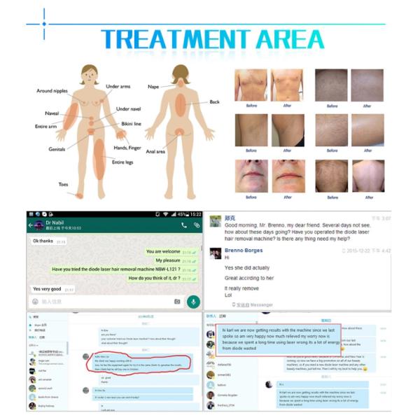 Alexandrite laser hair removal, diode laser hair removal machine,808nm diode laser