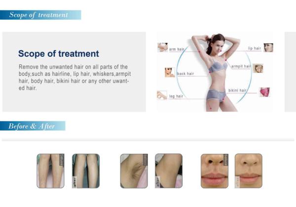 2019 hottest New design diode laser hair removal machine / 808nm laser diode machine / ice laser hair removal machine