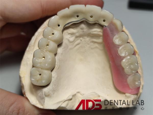 Dental Telescopic Crowns Prosthesis In Dentistry Customizable