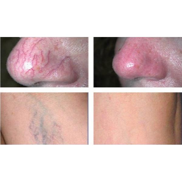 машина AC100-240V удаления пигментацией лазера 15W 30W 60W 980nm