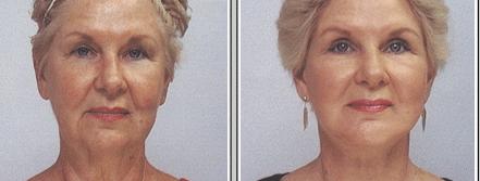 CE Approved Fractional RF Skin Tightening Machine For Skin Rejuvenation