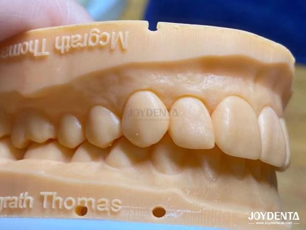 Lightweight and Smooth Dental Veneers Stain Resistance Long-lasting Durability for Optimal Comfort