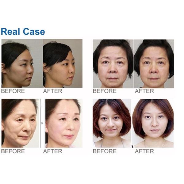 Mini Portable 3D Face Wrinkle Remover Machine , HIFU Face Lifting Machine