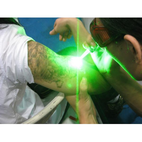 Q-Beam Plus™ Nd:Yag Lasers Tattoo Remover