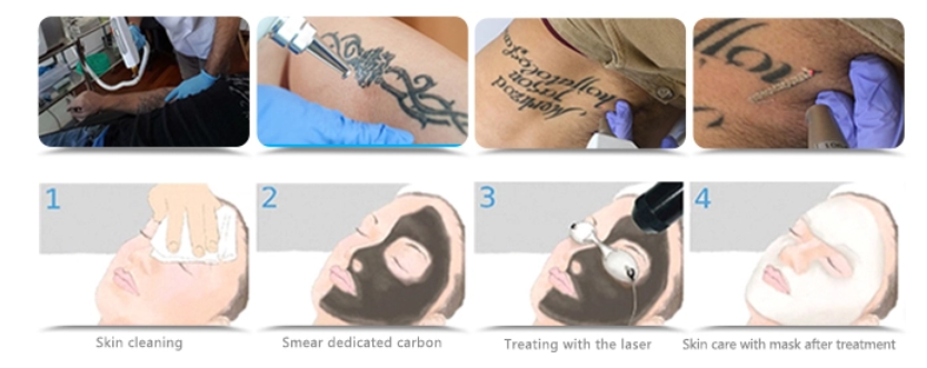 Customized 1064 Yag Laser Hair Removal , Nd Yag Laser Machine No Injury To Skin