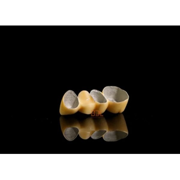 Durable Porcelain Fused To Metal Crown Customized Shade Matching Long Lasting Dental Restoration Solution