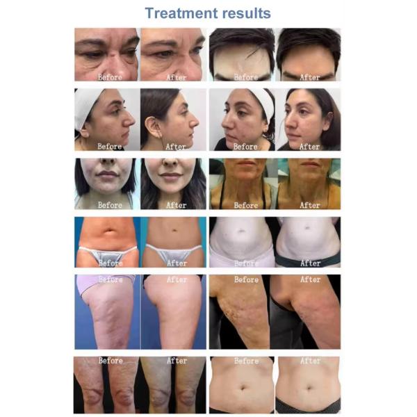 máquina fraccionaria 100V de 50W RF Microneedle a 240V