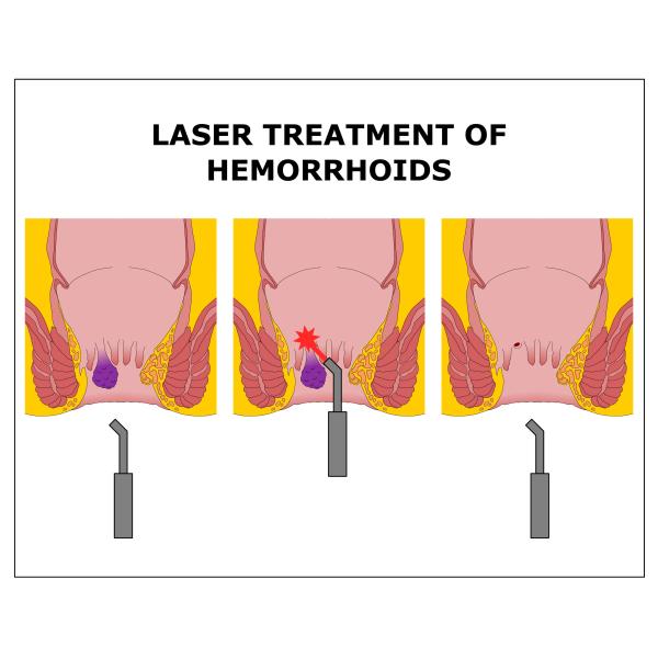 Ткань геморроев мягкая режа хирургическое удаление 980 1470nm вены паука машины лазера