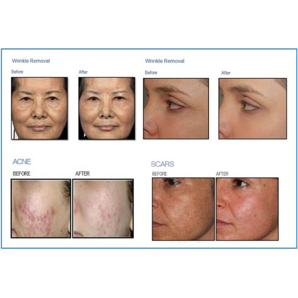 Vagina Tightening Beauty Therapy Equipment Scar Removal RF Fractional Co2 Laser Machine