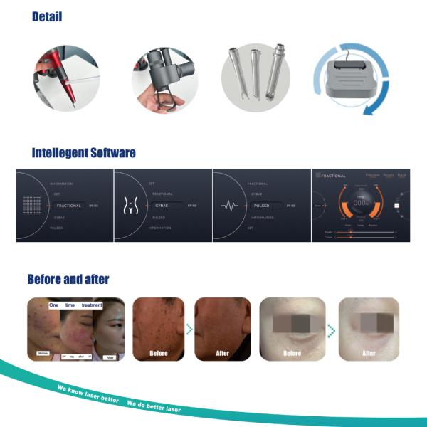 10600nm Fractional CO2 Laser Machine For Skin Resurfacing Scar Removal Wrinkle Reduction And Dermatology Treatments