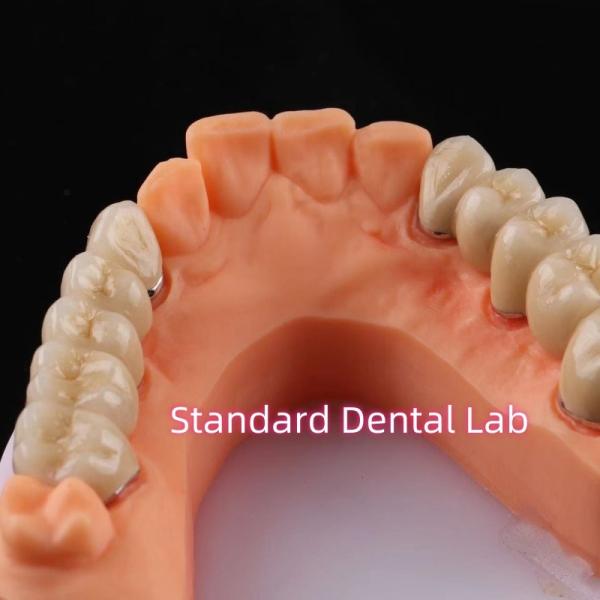 Цифровые недрагоценные металлические фарфоровые коронки PFM Bridge Dental