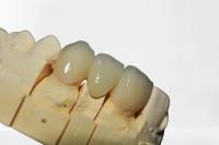 A ponte dental bonita da coroa veste a restauração natural que mastiga o poder