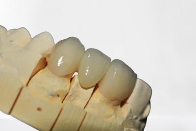 Good Stability Dental Crown Bridge Clean And Tidy High Quality Clean And Tidy