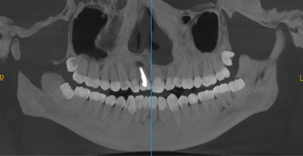 Dental Implant Orthodontic CBCT System High-Resolution 3D Imaging for Precise Diagnosis