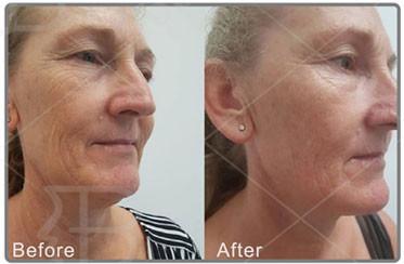 Máquina Hifu 12d Lifting Facial Profissional 2024 RF Apertar a Pele Emagrecimento do Corpo