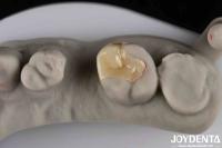 Strong Resistance To Fracture Emax Inlay Onlay Natural-looking Esthetics And Durability