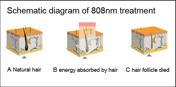 110V 220V Diode Laser Hair Removal Beauty Machine 808nm Painless For Permanent