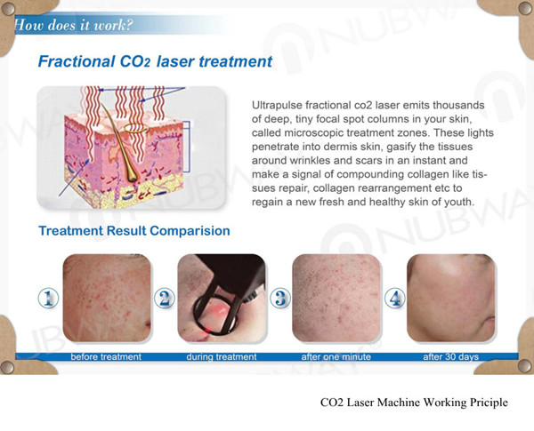 10600nm Fractional Co2 Laser Machine 50W For Skin Whitening