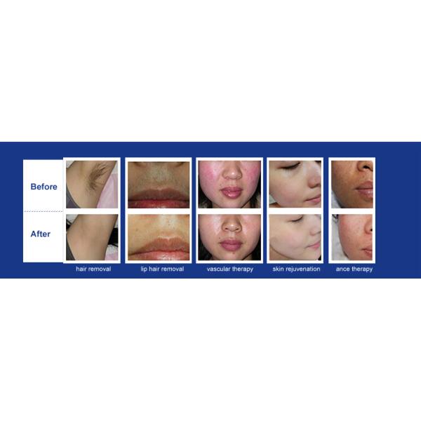 Hair Removal IPL Laser Machine