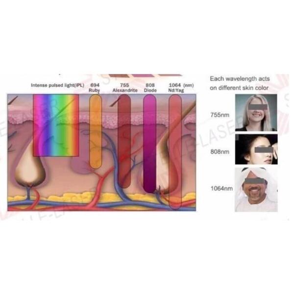 Triple Wavelength Diode Laser Hair Removal Machine 755 808 1064nm Available