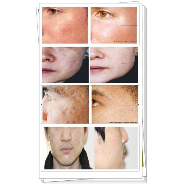 Professional fractional RF microneedle machine beauty salon equipment for face lifting