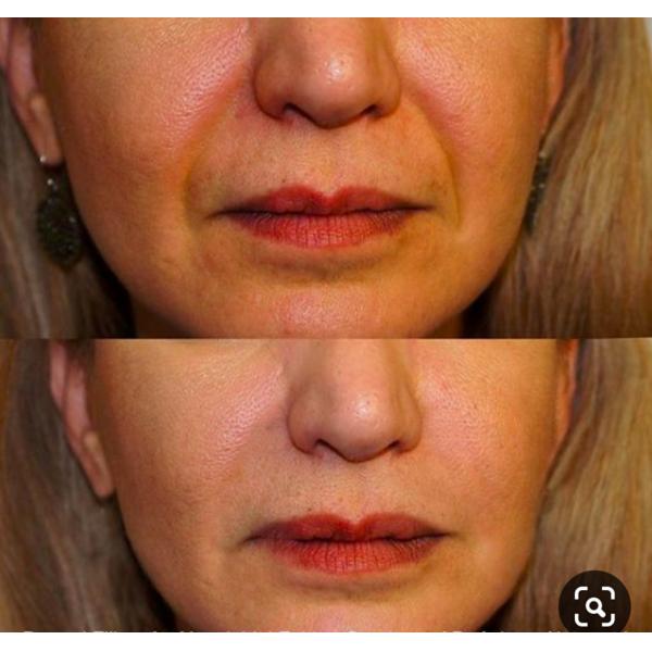 Сторона впрыски Ha наполнителя 1ml 2ml Derm Ha тонкой Derm глубокой Hyaluronic кислоты дермальная