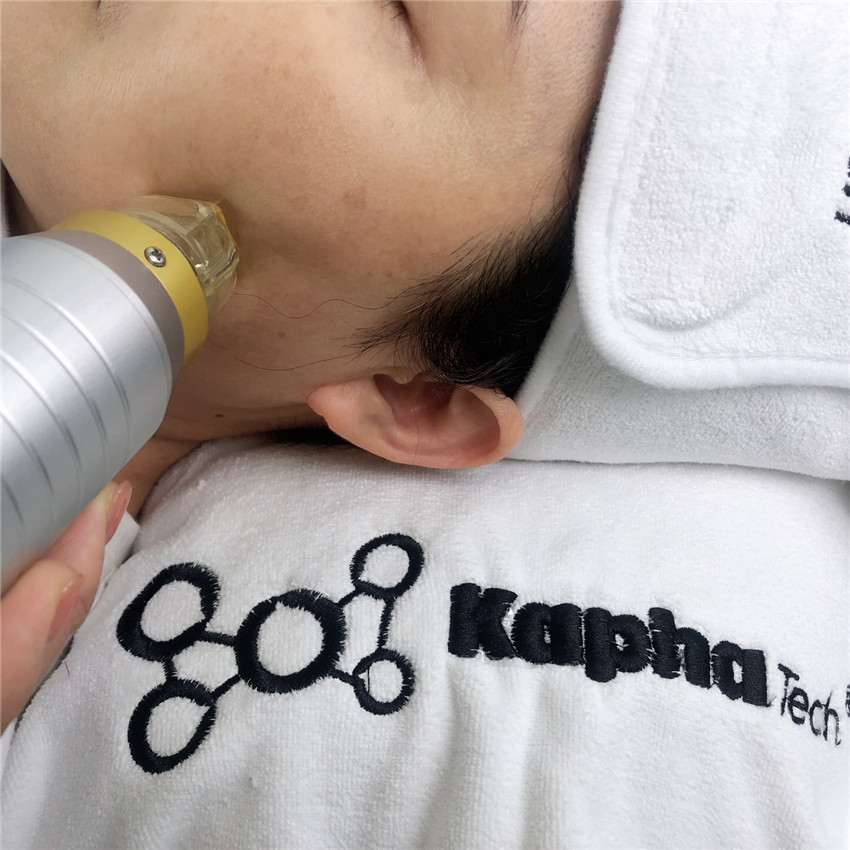 Степень Microneedling Frational RF удаления 45 меток Strectch