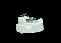 Implante dentário de coroa de titânio de longo prazo para substituição de dentes perdidos