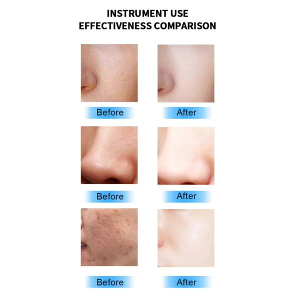 Утяжеление кожи Лечение прыщей Фракционное радиочастотное золотое устройство для микроиглы