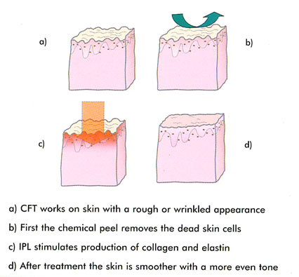 Best Selling IPL Hair Removal/Skin Rejuvenation/Vascular Removal Machine NBW-I323