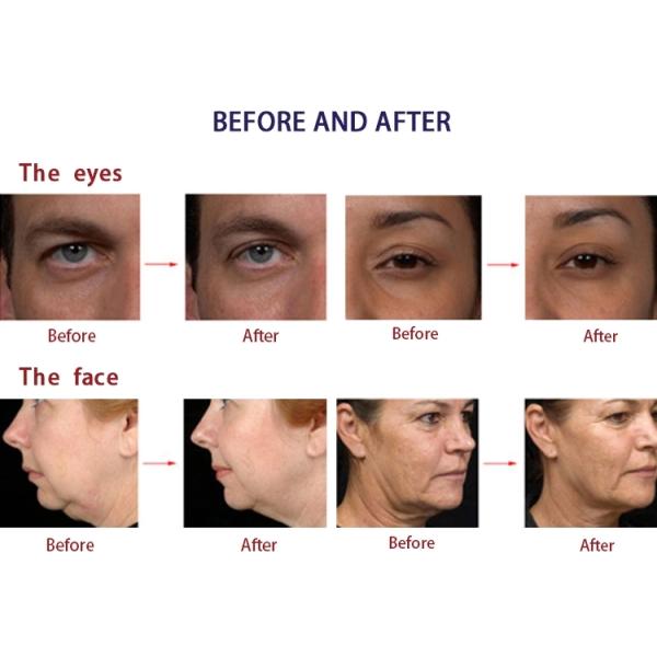 Кожа портативного ухода за лицом оборудования красоты РФ поднимаясь затягивая машину красоты удаления морщинки