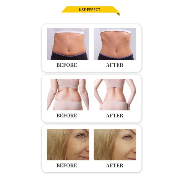 Ce Approved Rf Ultrasonic Fat Vaser Liposuction Machine Your Secret to a Perfect Body