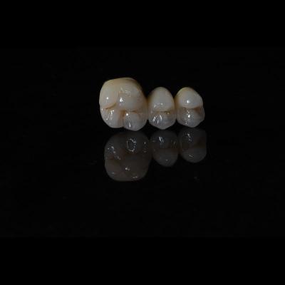 Anti Wear Implant PFM Dental Bridge Prosthesis Teeth Replacement