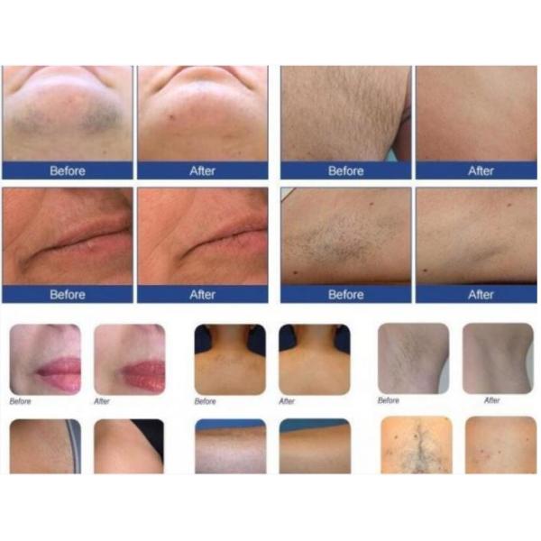 ODM 4000W Skin Therapy IPL Hair Removal Device OPT SHR Technology