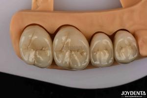 Premium Gold and Palladium Alloy Dental Crowns for Enhanced Durability