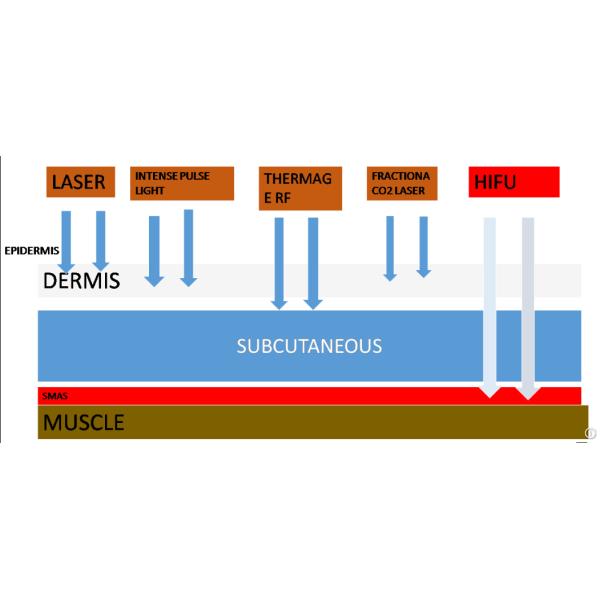 5 тело ухода за лицом голов HIFU поднимаясь уменьшая кожу затягивая машину красоты