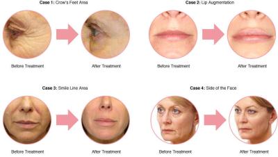 Top Pure Cross Link Super Hyaluronic Acid Filler for face lift