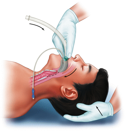 Авиалиния маски хирургического стандартного медицинского многоразового силикона Laryngeal с трубкой