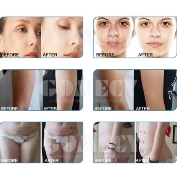 Vacuum Roller RF Slimming And Body Contouring Device Infrared Body Shaping And Skin Tightening Equipment