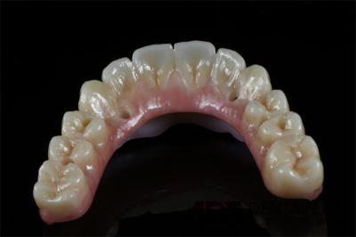 All On 6 Zirconia Dental Implant Supported Bridge Full Arch Custom