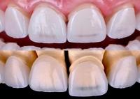 Finete dentário EMAX de longa duração fabricado com material cerâmico de zircônio