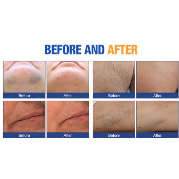 808nm Diode Laser Hair Removal Machine , Alexandrite Laser Hair Removal