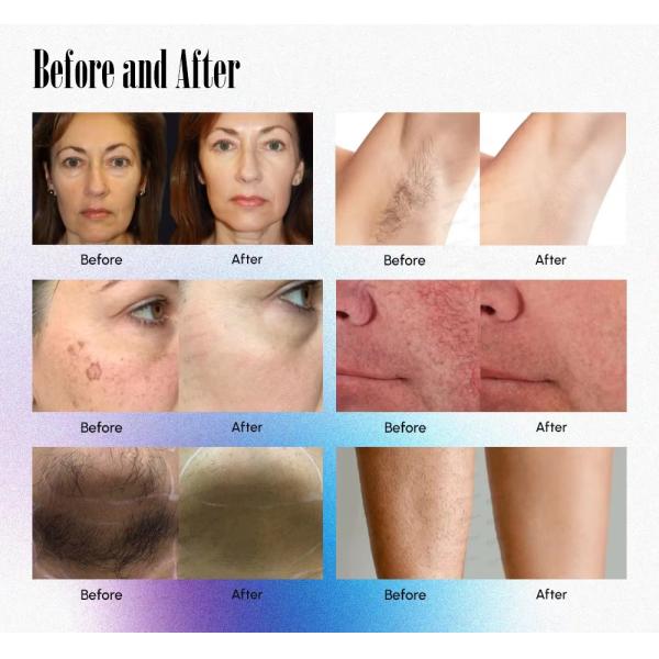 Alexandrite Laser Double Wave 755Nm 1064Nm Long Pulse Nd Yag Laser Hair Removal Machine