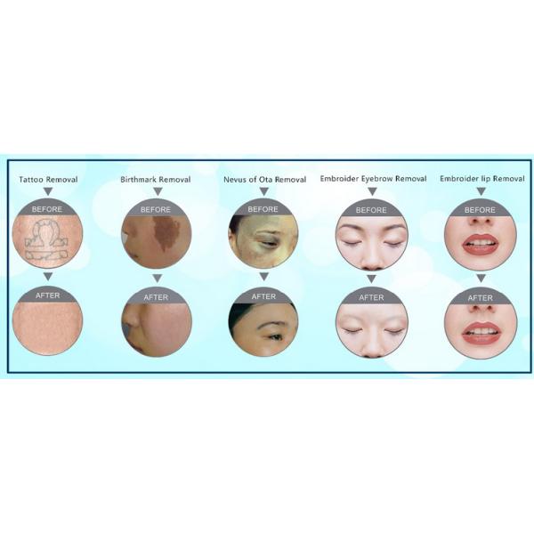 professional laser tattoo removal Portable Q Switched Nd Yag Laser Tattoo Removal Machine Color Touch Screen CE Approved