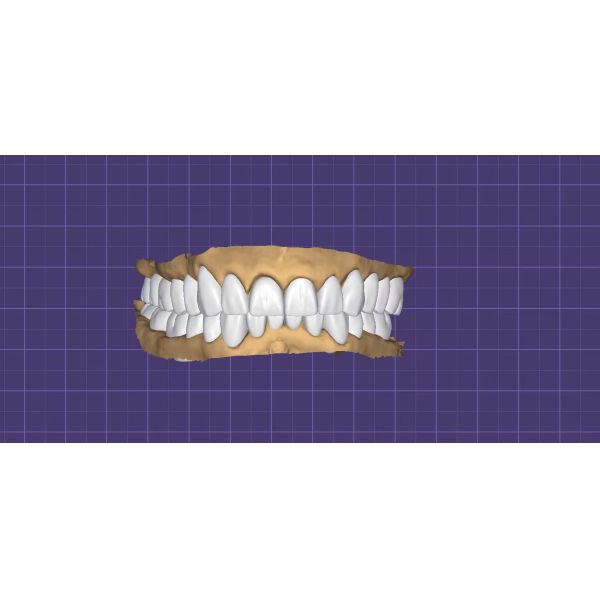 Precision Fit Digital Wax Up Dental Study Model with Durable and Biocompatible 3D Printed Design