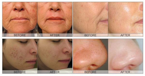 Multifunction Diamond Hydro Microdermabrasion Machine Non Surgical for Facial Lift