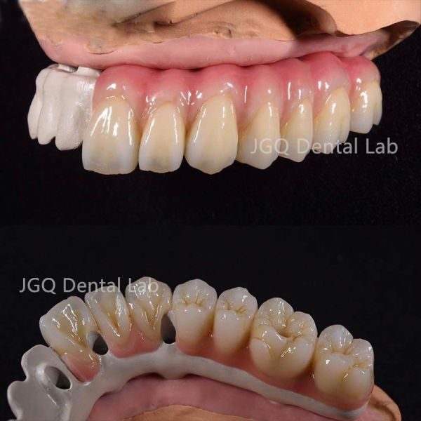 All On 6 Dental Implants Fixed Dentures Dental Lab All Ceramic FDA CE Certificated